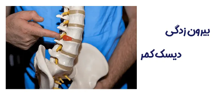 بیرون زدگی دیسک کمر