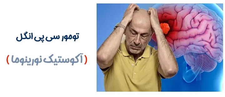 تومور سی پی انگل