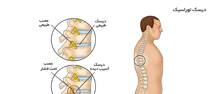 دیسک توراسیک