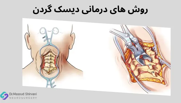 روش های درمانی دیسک گردن