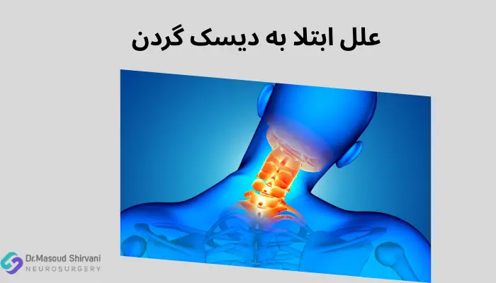 علل ابتلا به دیسک گردن