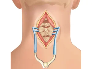 عمل دیسک گردن