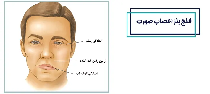 فلج بلز اعصاب صورت