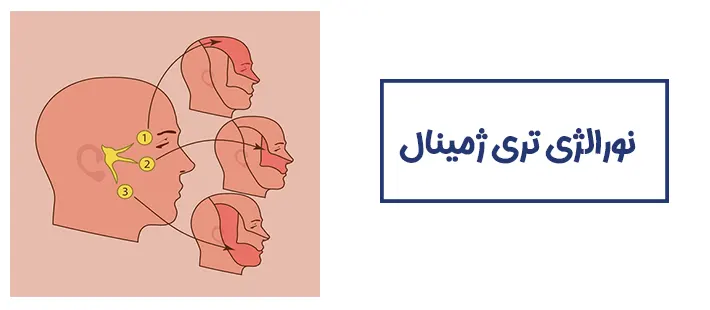 نورالژی تری ژمینال