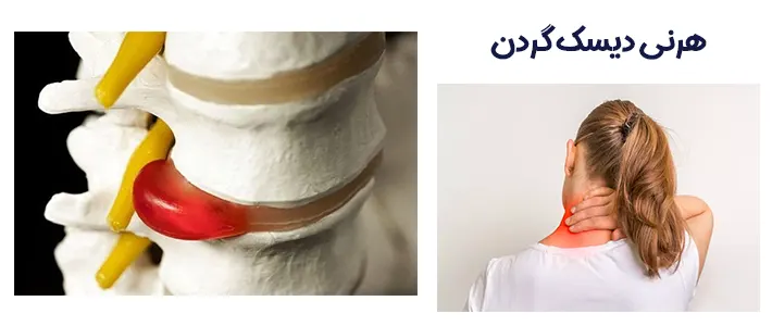 بیرون زدگی دیسک گردن