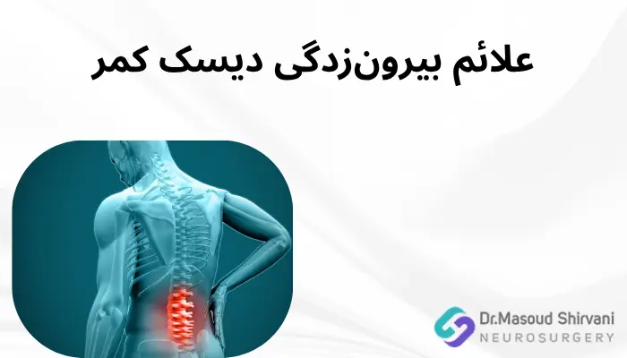 علائم بیرونزدگی دیسک کمر