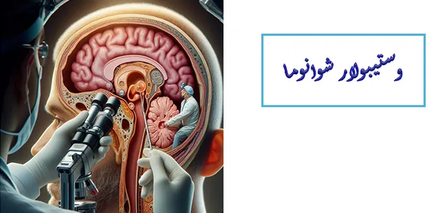 وستیبولار شوانوما