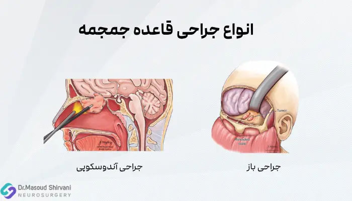 انواع جراحی قاعده جمجمه