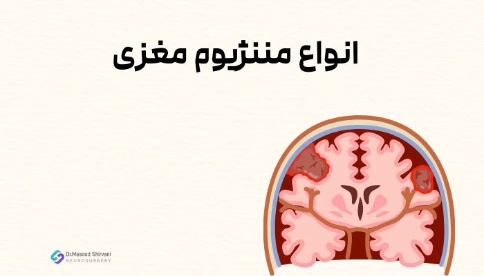 انواع مننژیوم مغزی