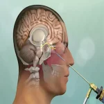 عمل قاعده جمجمه نکات