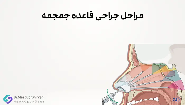 مراحل جراحی قاعده جمجمه