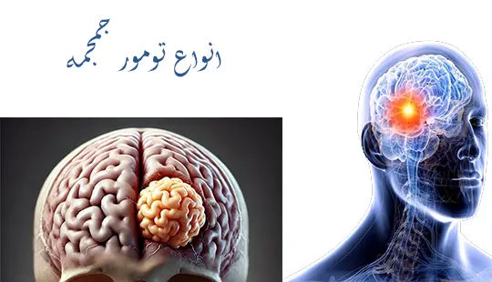 انواع تومور جمجمه