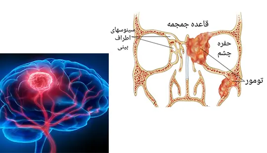 تومور قاعده جمجمه