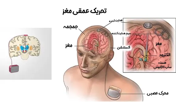 تحریک عمقی مغز