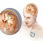 جراحی dbs