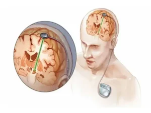 جراحی dbs