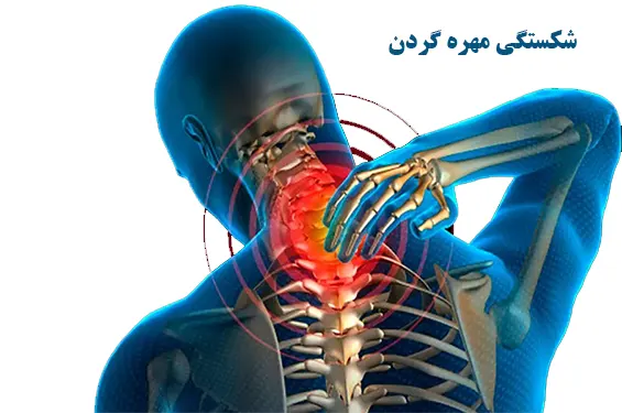 شکستگی مهره های گردن