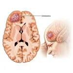 تومور مغز گلیوما