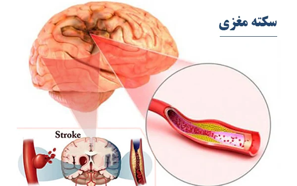 سکته مغزی