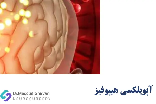 آپوپلکسی غده هیپوفیز