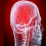آپوپلکسی هیپوفیز