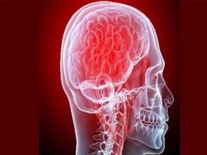 آپوپلکسی هیپوفیز