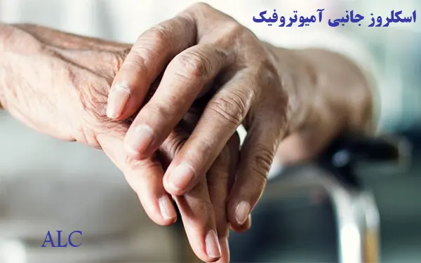 اسکلروز  آمیوتروفیک