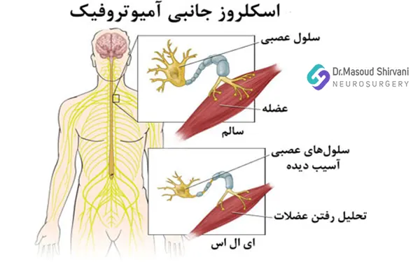 اسکلروز جانبی آمیوتروفیک
