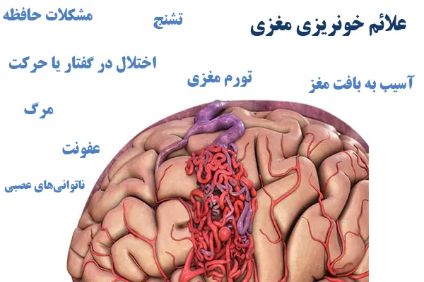 علائم خونریزی مغزی 