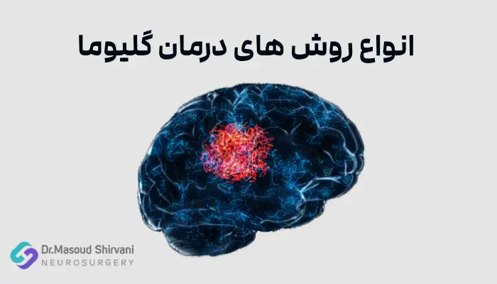 انواع روش های درمان گلیوما