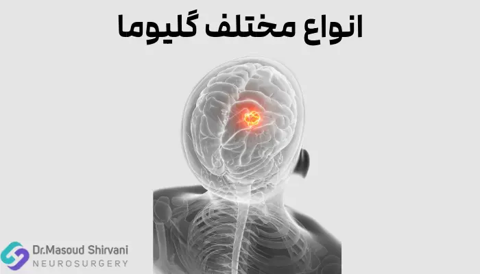 انواع مختلف گلیوما