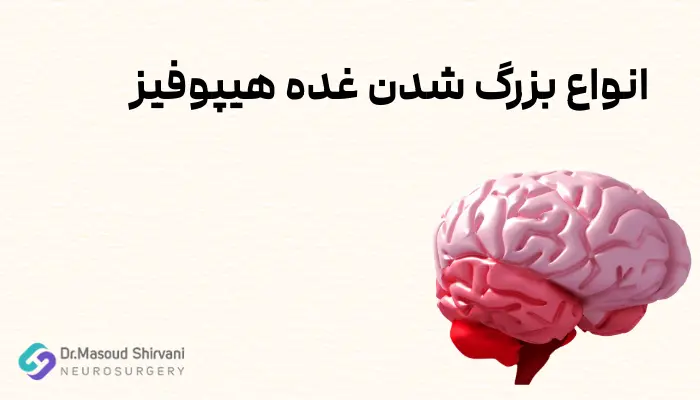 انواع بزرگ شدن غده هیپوفیز