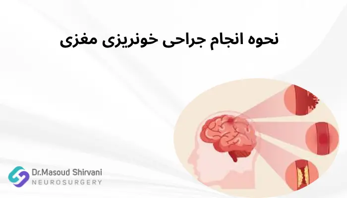نحوه انجام جراحی خونریزی مغزی نحوه انجام جراحی خونریزی مغزی