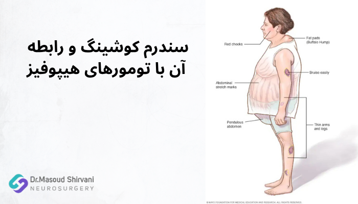 سندرم کوشینگ و رابطه آن با تومورهای هیپوفیز سندرم کوشینگ و رابطه آن با تومورهای هیپوفیز